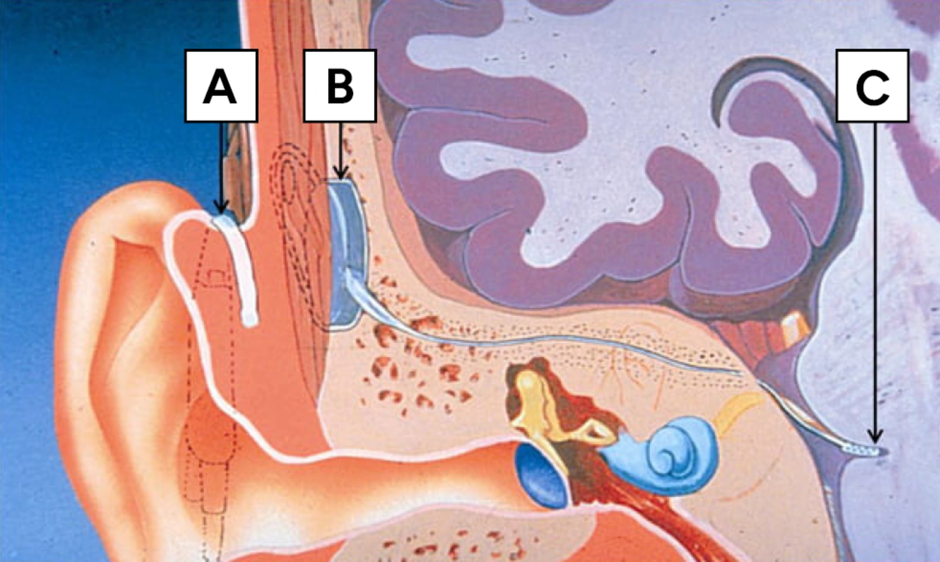 Illustration of an inner ear with impant inside and around top of ear